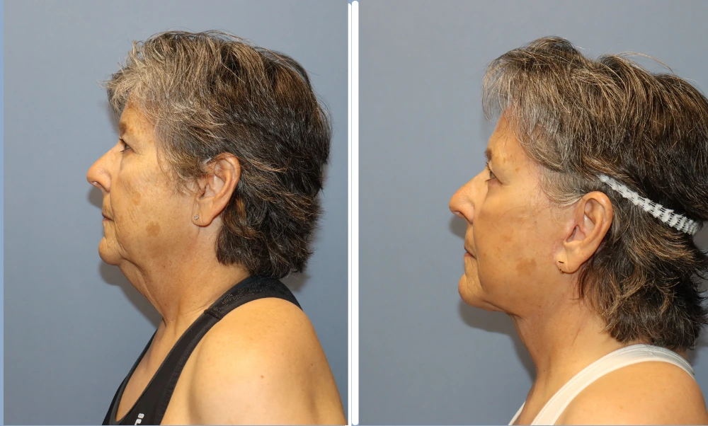 Facelift patient's profile view showing facial contour improvement and skin tightening results