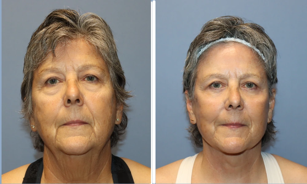 Facelift before and after: patient's face showing reduced sagging and improved contours post-procedure