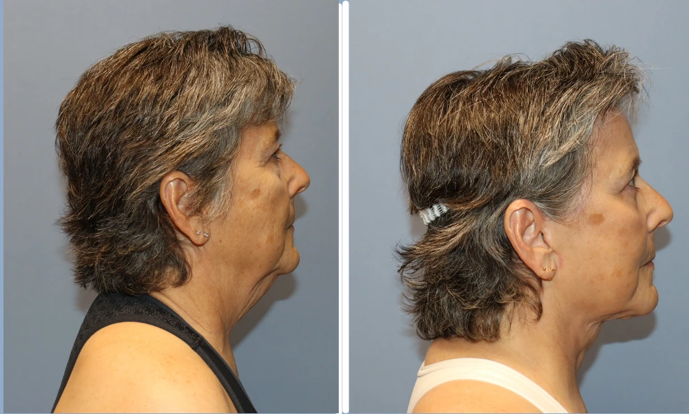 Facelift Case 7: before and after profile views showing improved facial contours and skin tightness