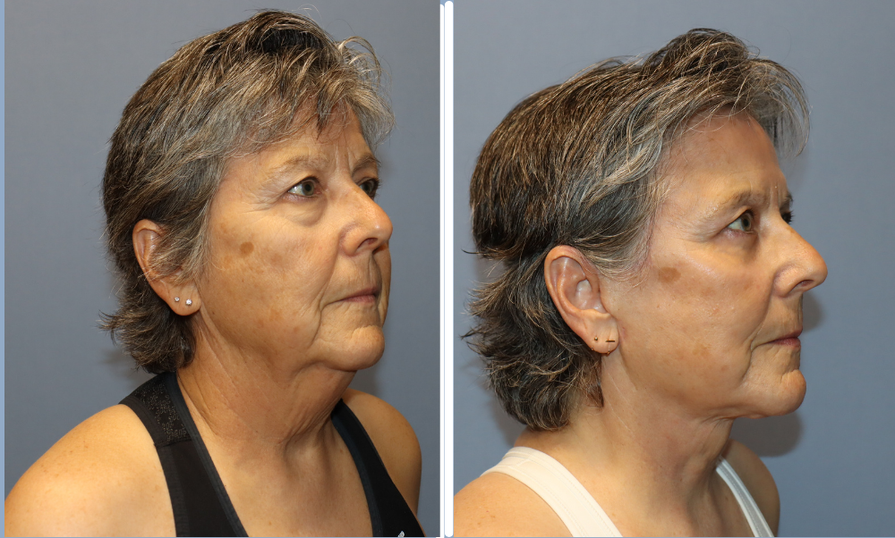 Facelift patient before and after results, side profile view showing improved jawline definition and facial contours
