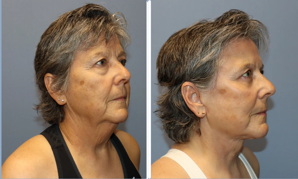 Facelift patient before and after results, side profile view showing improved jawline definition and facial contours