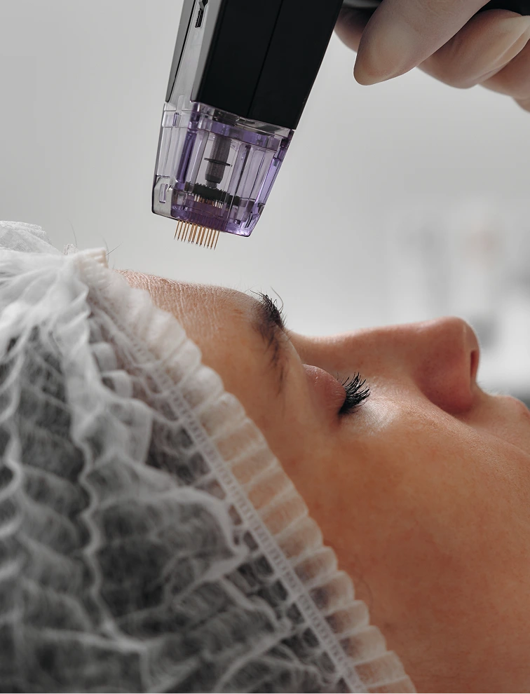 Microneedling device with fine needles positioned above patient's forehead during treatment
