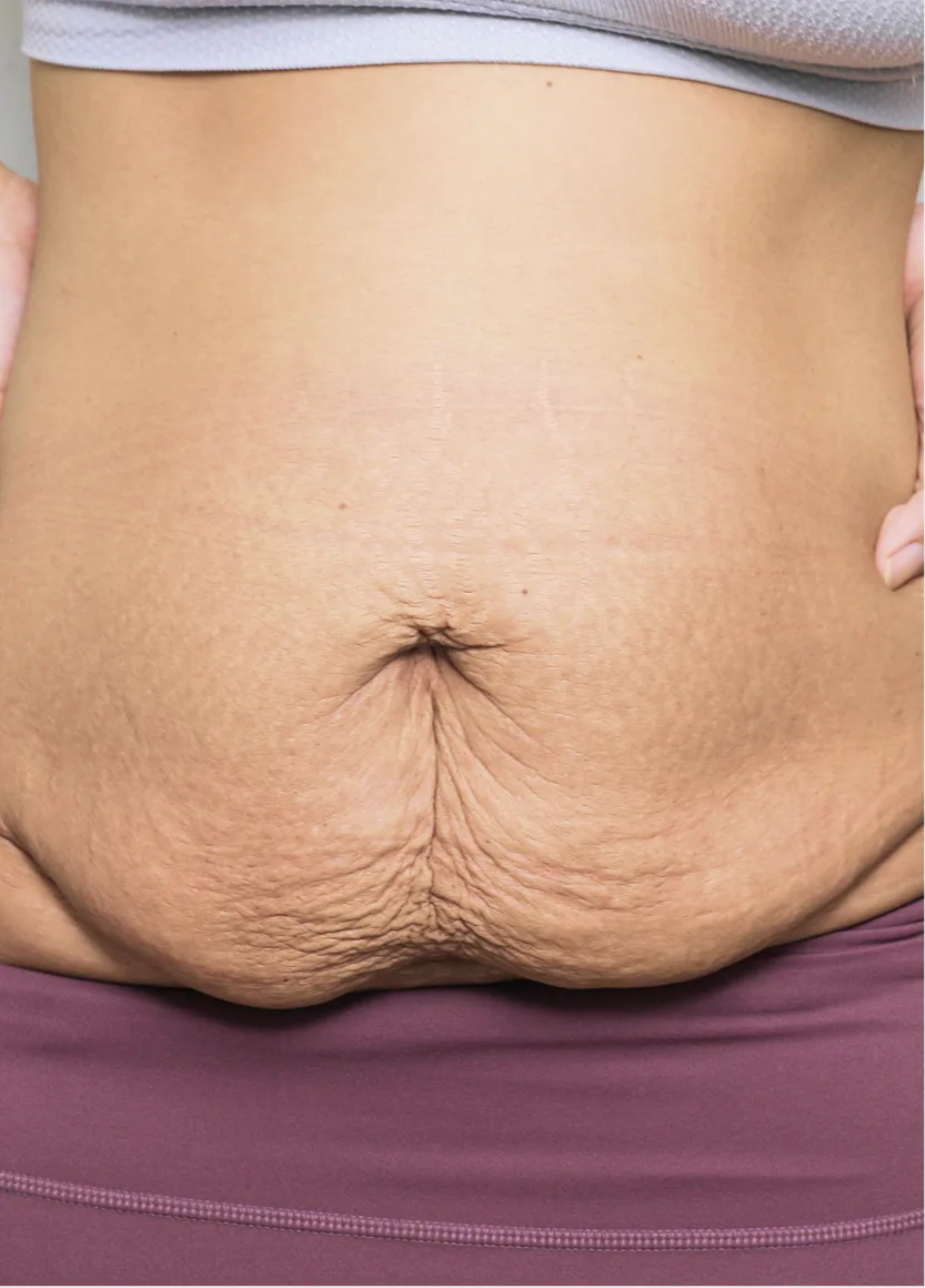 Patient's abdomen showing excess skin and laxity before Fleur de Lis tummy tuck procedure