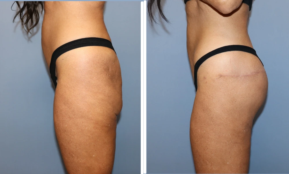 Before and after buttock lift results showing improved contour and projection from side view
