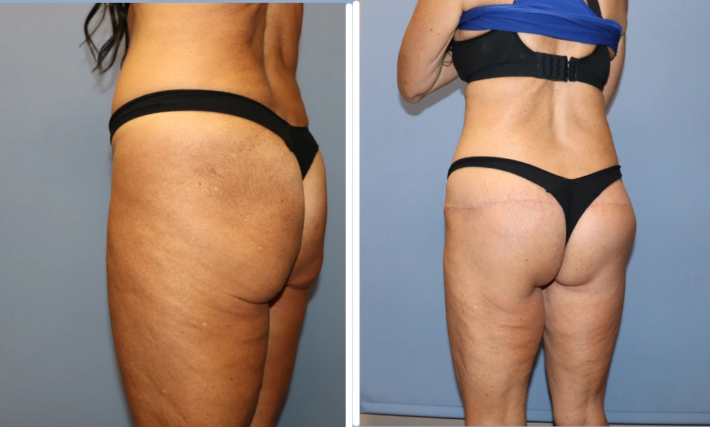 Before and after buttock lift results showing improved contour and lifted appearance from back view