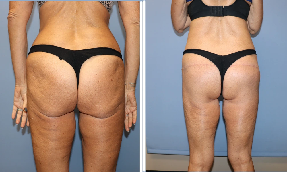 Before and after buttock lift results showing improved contour and skin tightness