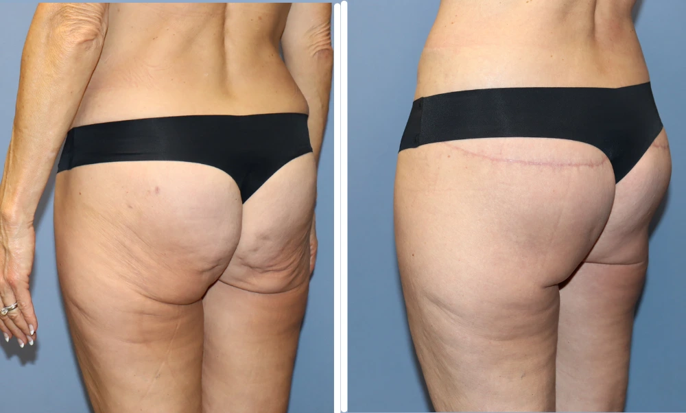 Buttock lift before and after results showing improved contour and elevation