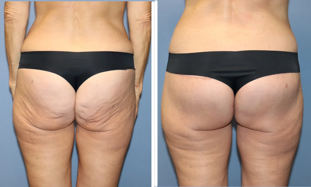 Buttock lift before and after comparison showing improved contour and lift