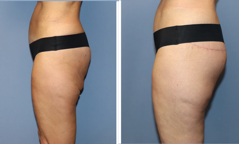 Before and after buttock lift results showing improved contour and lift from side view