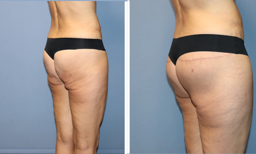 Buttock lift before and after comparison showing improved contour and lifted appearance