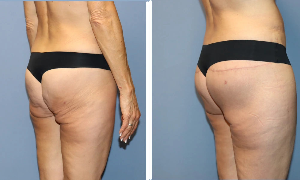 Buttock lift before and after comparison showing improved lift and contour from rear view