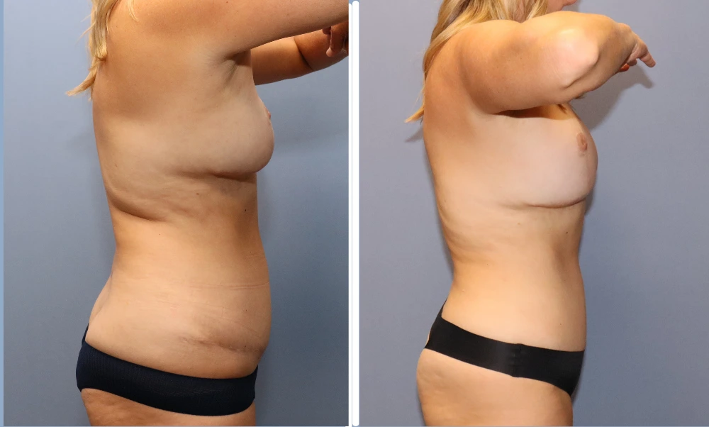 Liposuction case 5: before and after side profile showing torso and abdomen
