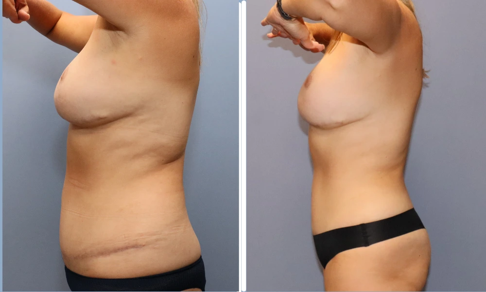 Before and after liposuction results showing torso profile view with reduced abdominal fullness