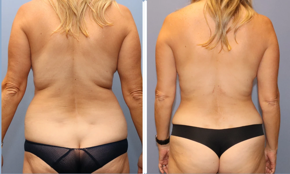 Liposuction Case 5: before and after rear view showing reduced flanks and improved body contour