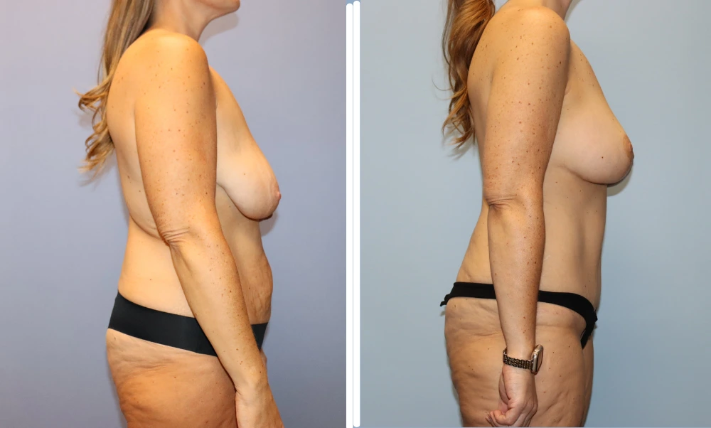Mommy Makeover Case 6 before and after results showing side profile comparison