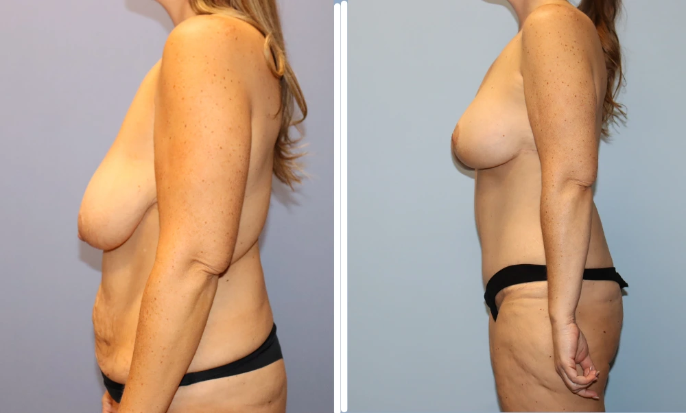 Mommy Makeover Case 6 before and after results showing side profile comparison