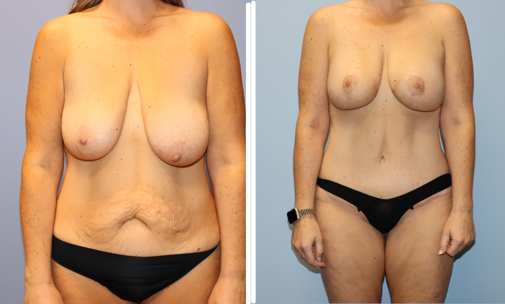 Mommy Makeover Case 6 before and after, frontal view showing breast lift and body contouring results
