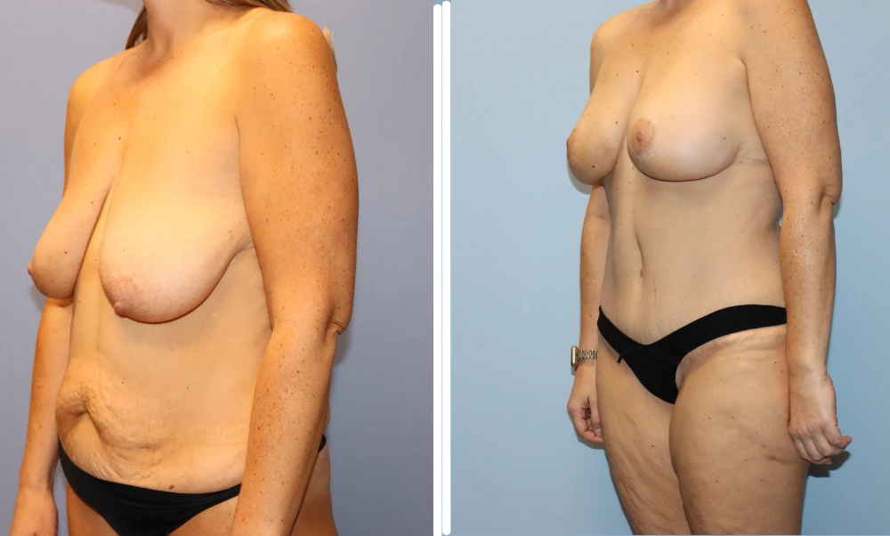 Mommy Makeover Case 6 before and after results showing breast lift and body contouring from oblique view