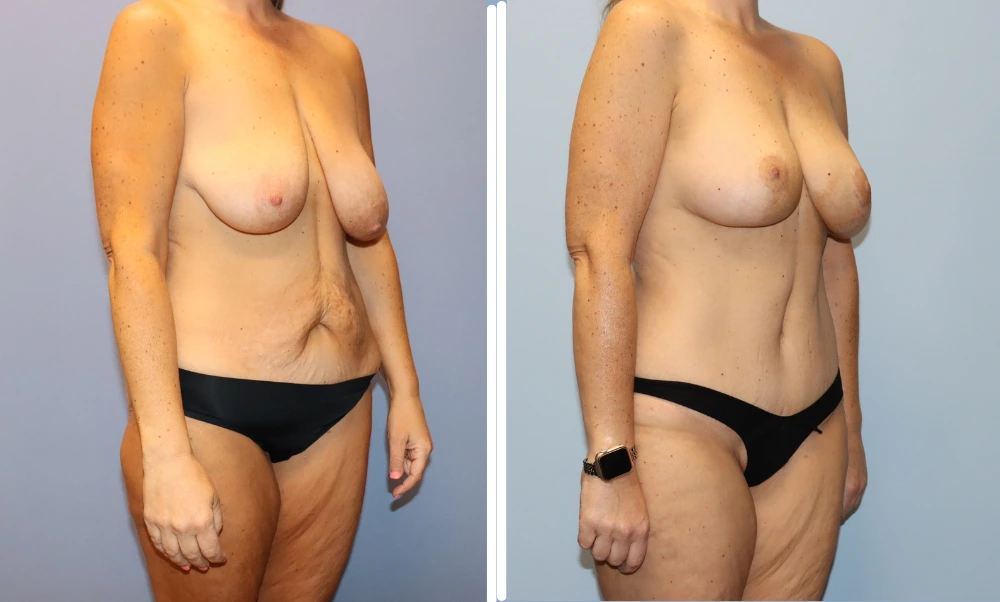Mommy Makeover Case 6 before and after results showing improved breast contour and abdominal appearance