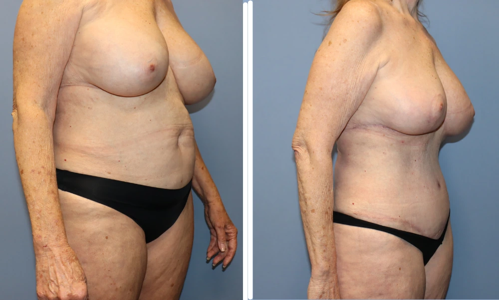 Mommy Makeover Case 7 before and after results showing patient's torso from the side