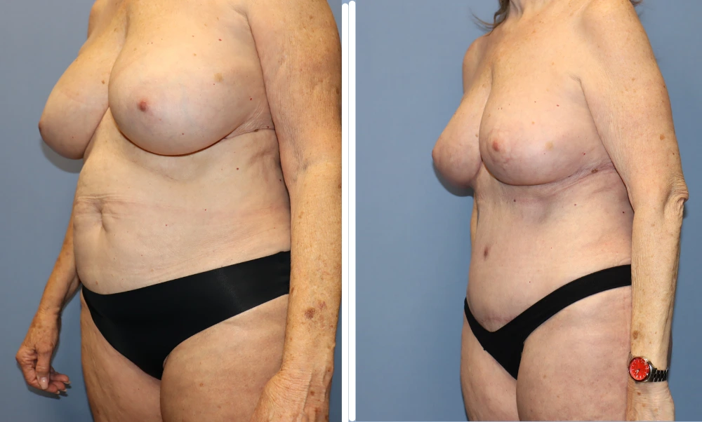 Mommy Makeover Case 7 before and after results showing chest and abdominal contouring