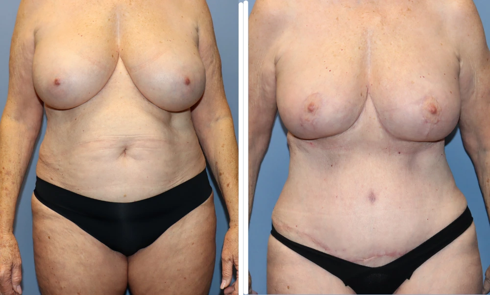Mommy Makeover Case 7: before and after front view showing breast and abdominal results