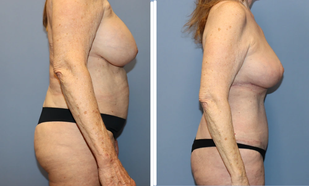 Mommy Makeover Case 7 before and after side profile view showing breast and abdominal contouring results