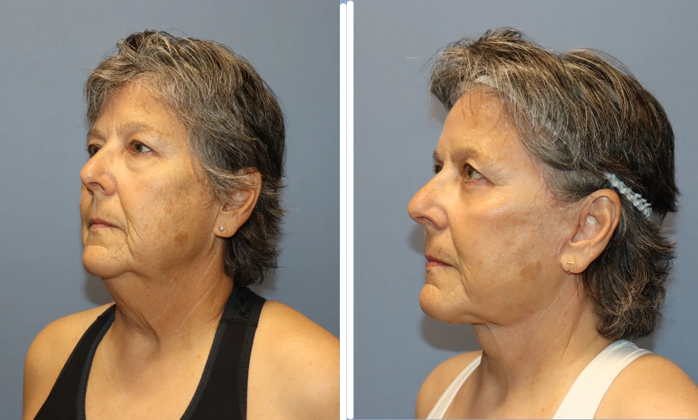Patient before and after neck lift, showing improved definition and reduced laxity in profile view