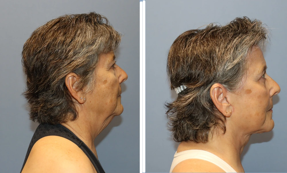 Before and after neck lift results showing improved jawline and neck contour from side profile