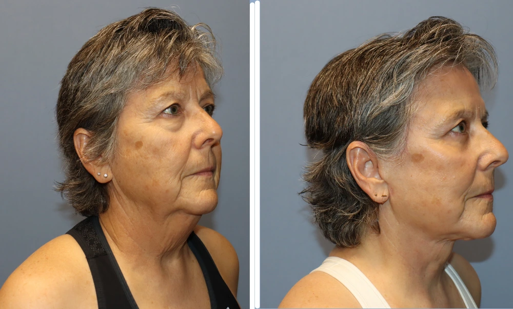 Before and after neck lift results showing improved neck contour and definition from side profile view