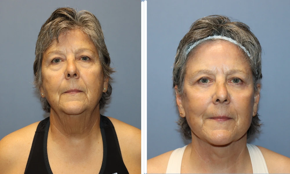 Before and after neck lift results showing improved neck definition and jawline contour