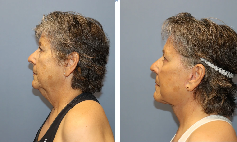 Before and after neck lift results shown in side profile view