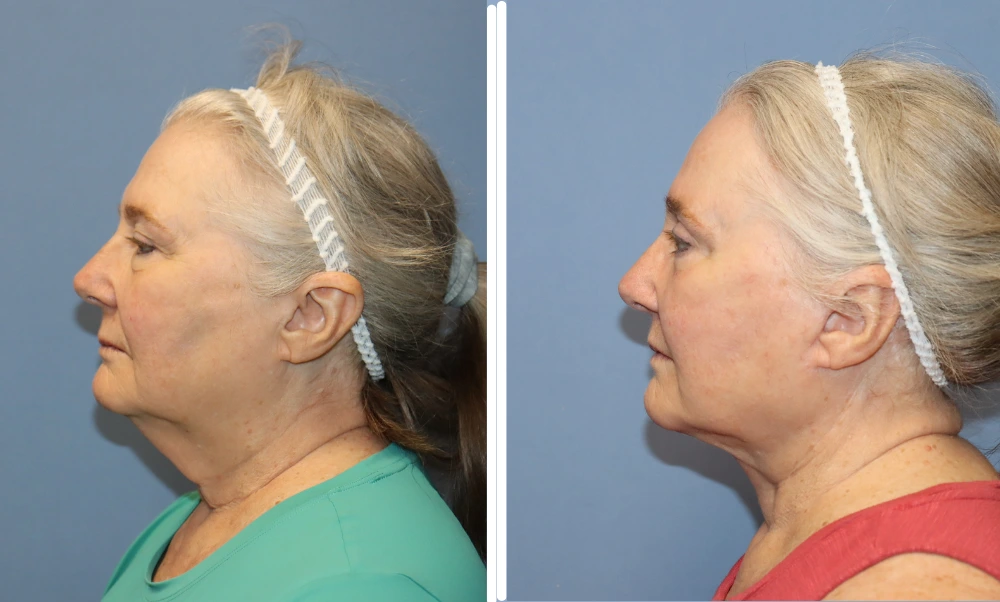Before and after neck lift results showing improved jawline definition and reduced neck laxity