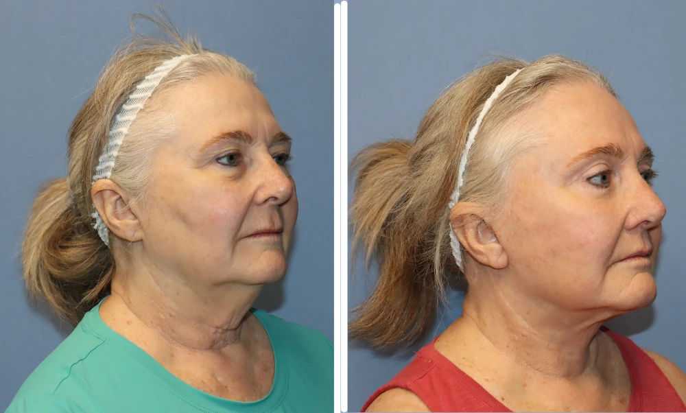 Neck lift before and after comparison, side profile view showing improved neck contour and definition