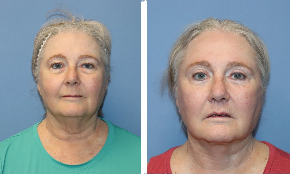Before and after neck lift results showing improved neck contour and skin tightness