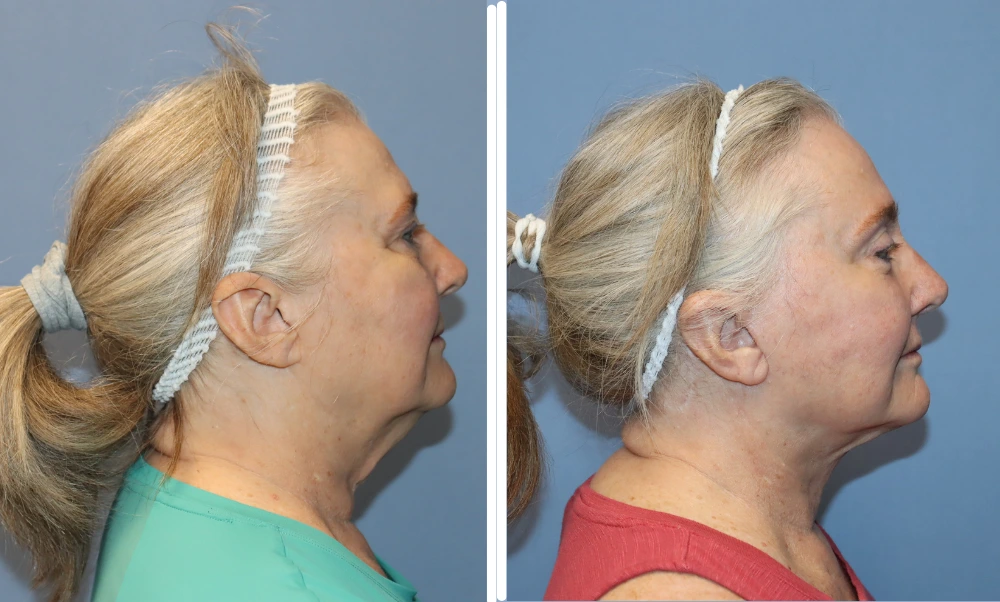 Before and after profile views of neck lift results showing improved neck contour and definition