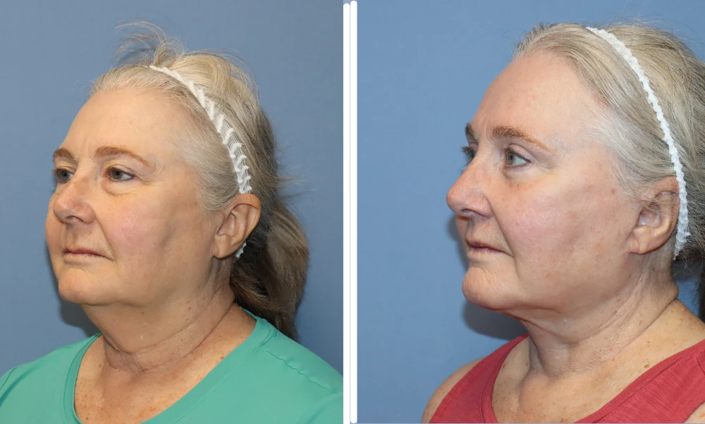 Neck lift case 5: before and after profile views showing improved neck contour and definition