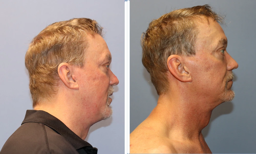 Neck lift patient before and after results shown in side profile