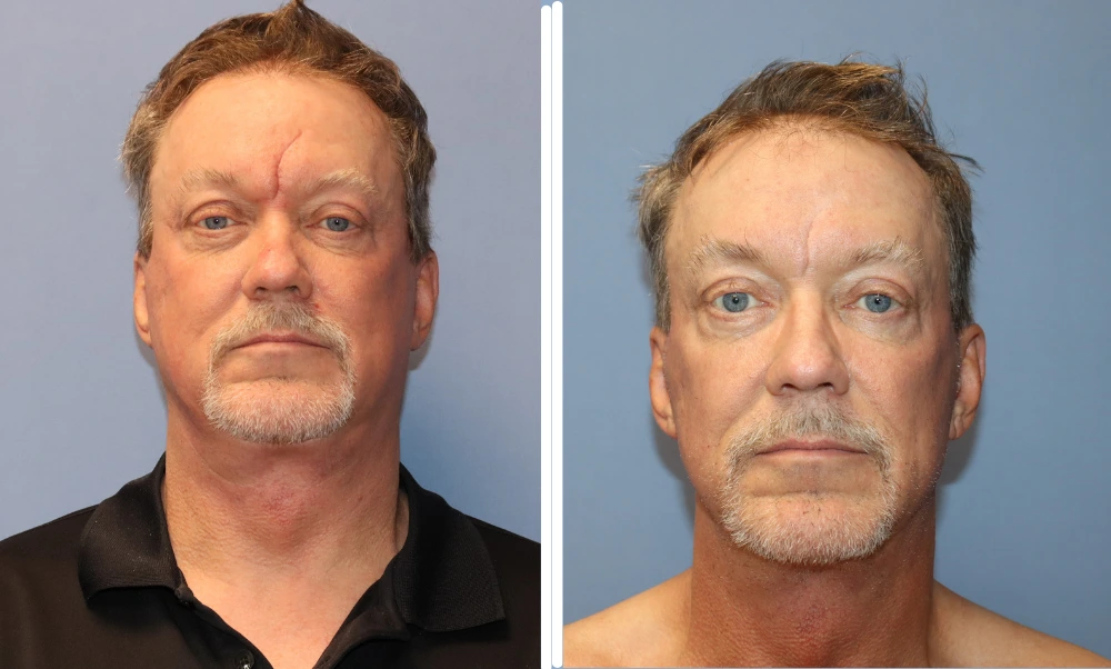Before and after neck lift results showing improved jawline definition and reduced neck laxity