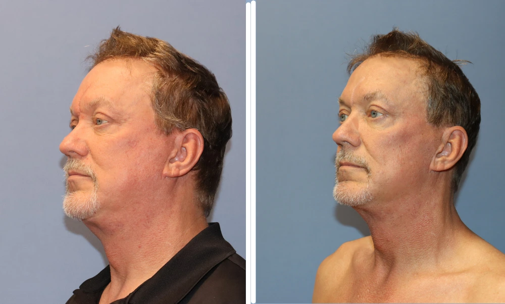 Before and after profile view of neck lift results showing improved neck contour and definition