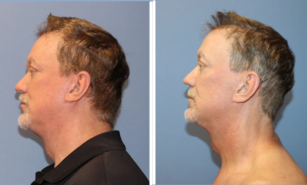 Before and after profile views of a neck lift case showing improved jawline definition and neck contour