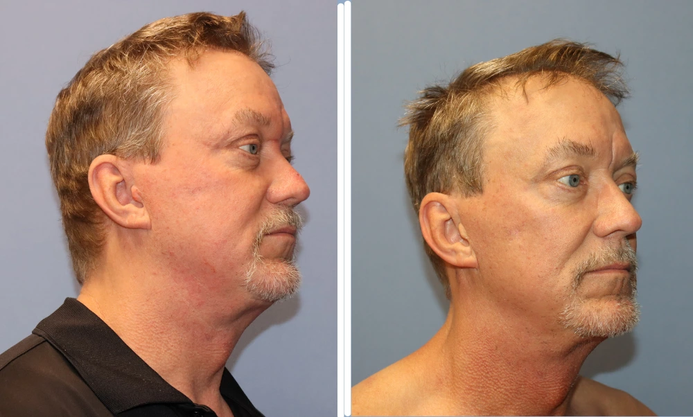 Male patient profile view before neck lift surgery showing loose neck skin and definition loss