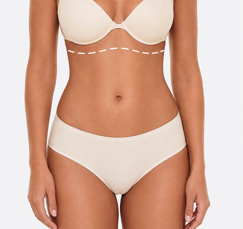 Woman's torso showing surgical marking lines across abdomen for reverse tummy tuck procedure