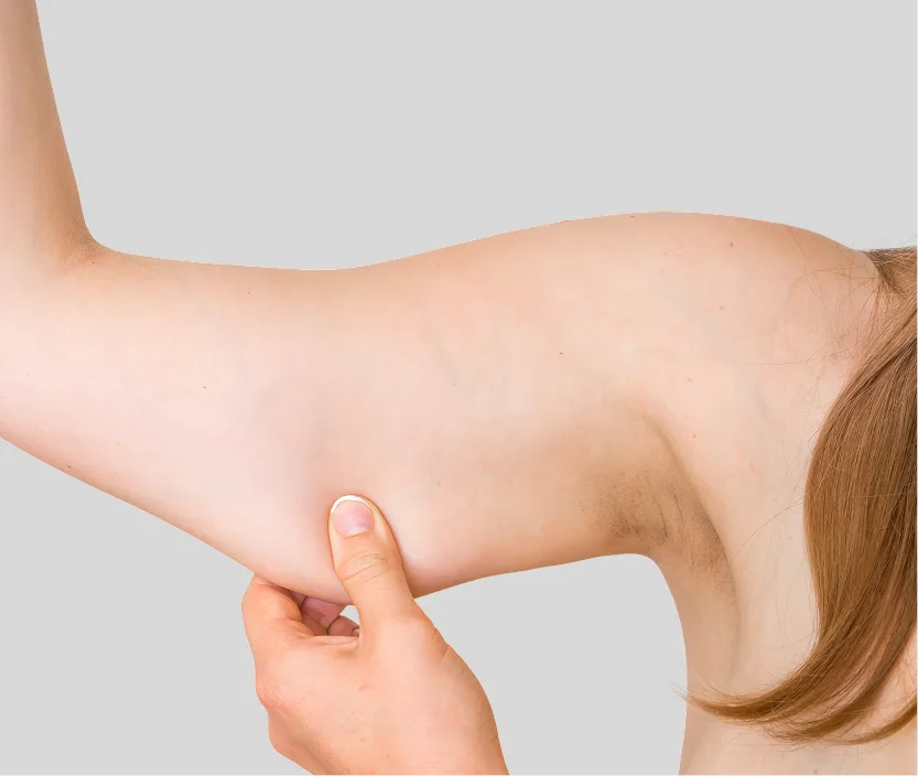 Woman pinching underside of arm to demonstrate loose skin