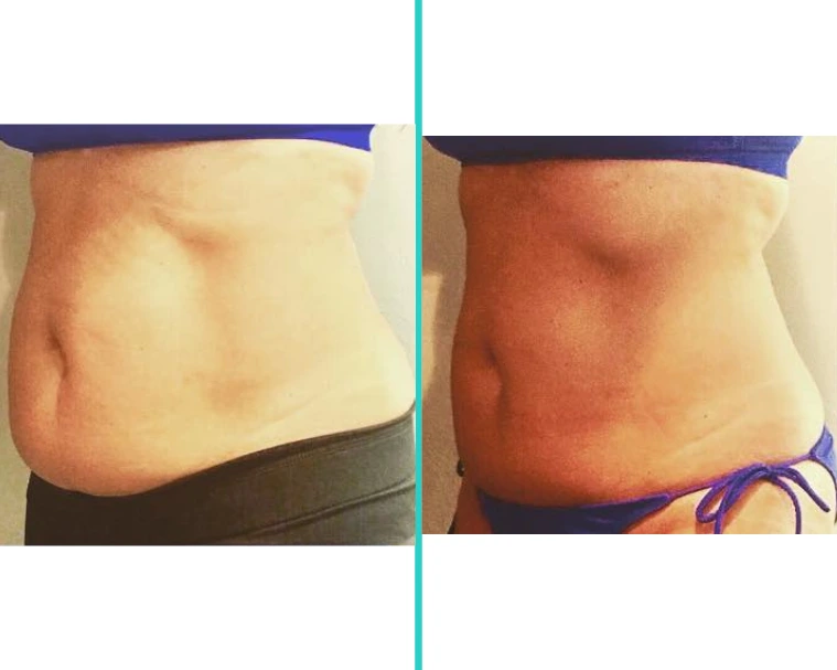 Coolsculpting 7.1