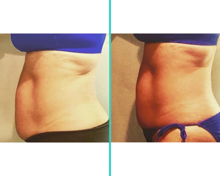 Coolsculpting 7.2