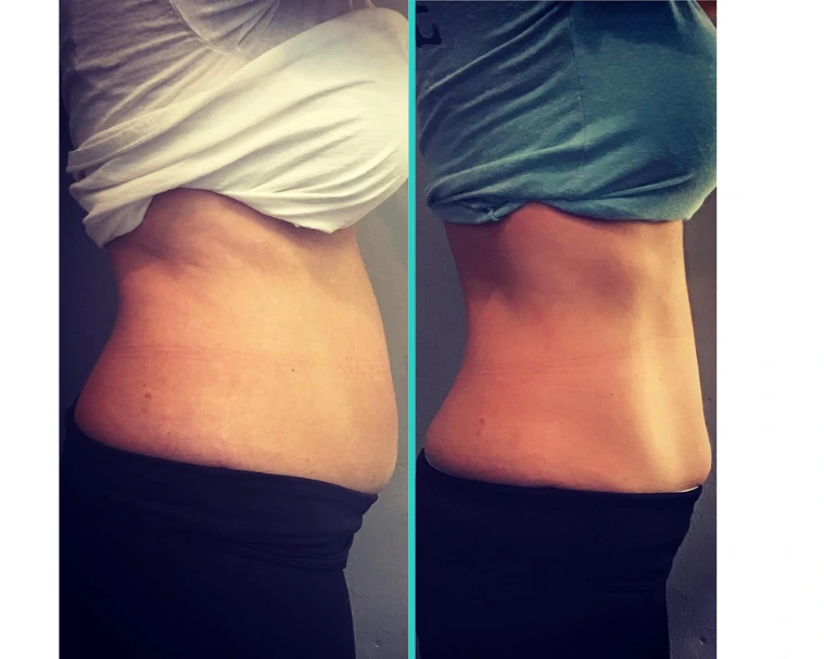 Coolsculpting 8.1