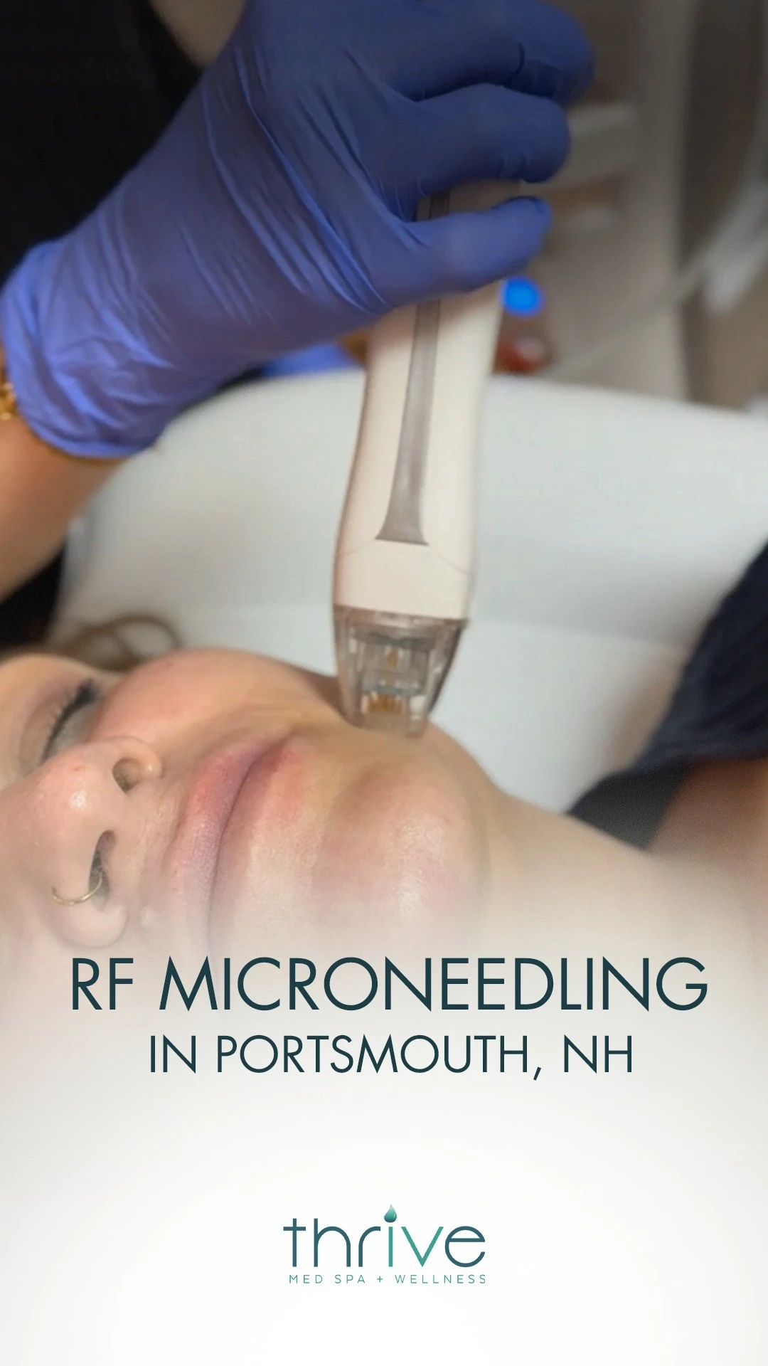 Provider in blue gloves performing RF microneedling treatment on patient's cheek at Thrive Med Spa & Wellness in Portsmouth, NH