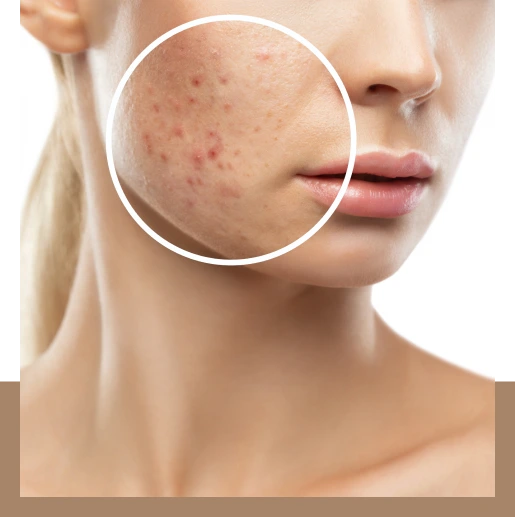 Different Types of Acne Scars Banner