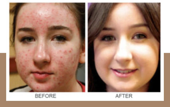 Expect After Acne Scar Removal Banner